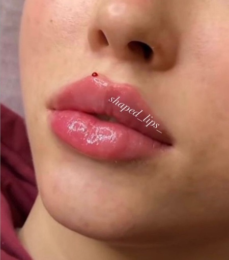 Kusadasi Lip Appointments